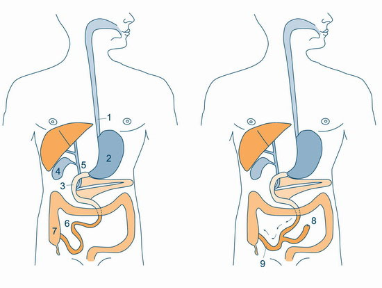 Jejunoileal bypass.