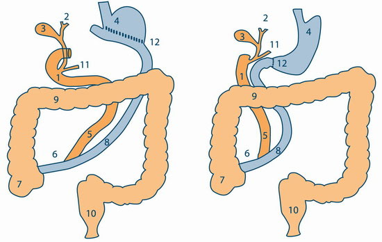 Two variants of biliopancreatic bypass. 