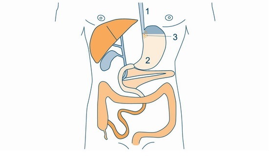 The basic concept of both operations is similar, andthey use the same mechanism of weight loss.