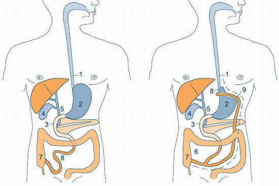 Laparoscopic Gastric bypass : Bariatric surgery in Russia