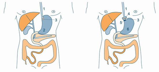 Laparascopisk adjustable gastric banding : bariatric surgery in Russia