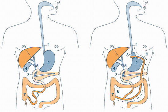 Laparascopisk gastric bypass