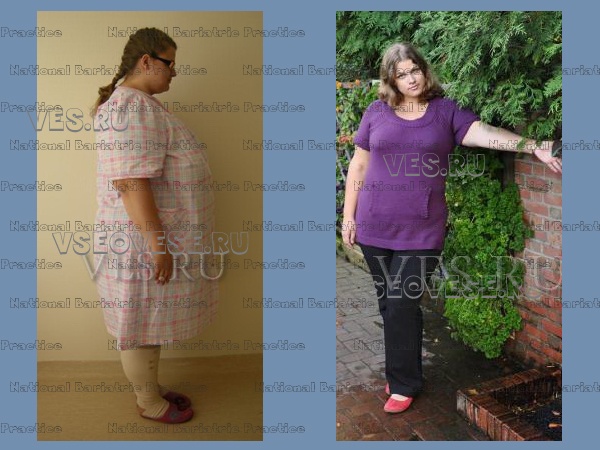 Снижение Веса После Шунтирования Желудка